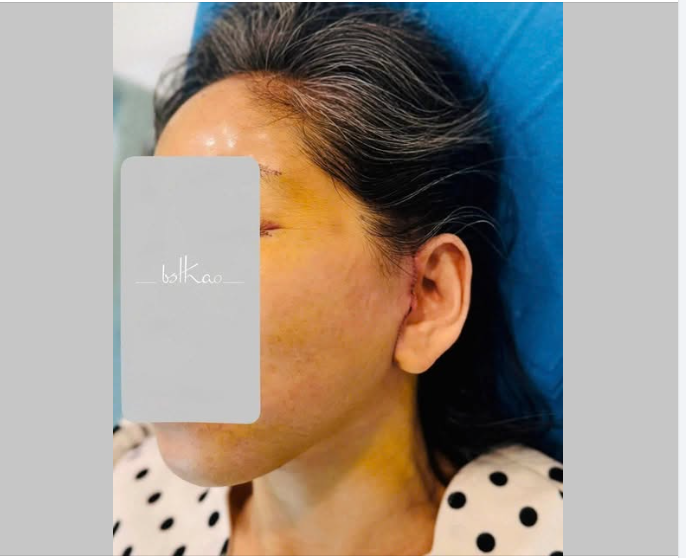 KẾT QUẢ NGÀY THỨ 2 CỦA 1 CASE PT TRẺ HÓA TOÀN DIỆN