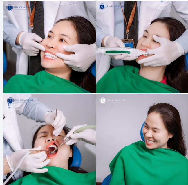 Cận cảnh bộ 20 răng sứ của chị Linh – Vĩnh Phúc sau 6 năm tái khám tại Nha Khoa Shinbi