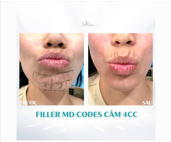CỨ MỖI LẦN CỬ ĐỘNG NÓI CƯỜI, CHU MÔI LÀ CẰM LẠI NHĂN NHÚM - CẢI THIỆN NHƯ THẾ NÀO?
