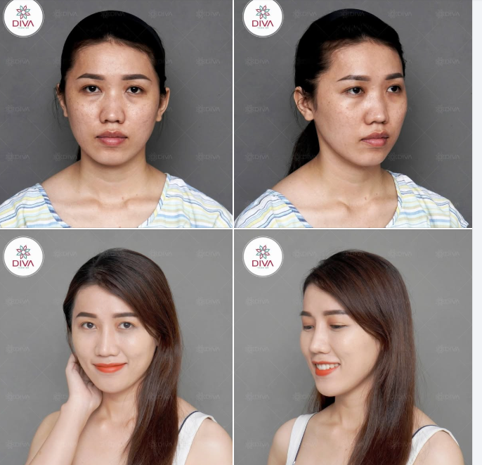 TỪ KHUÔN MẶT "THIẾU SỨC SỐNG” ĐẾN GƯƠNG MẶT TƯƠI TẮN, TỰ TIN CHỈ SAU VÀI TUẦN