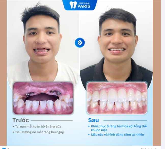 Anh Đinh Quang Huy từng rất mặc cảm khi còn trẻ đã mất răng, lại là 6 răng cửa – vị trí dễ thấy nhất khi cười nói.