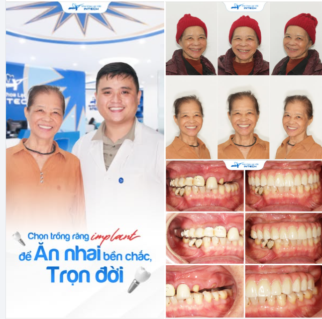 U70 VẪN ĂN NGON, NHAI TỐT NHỜ GIẢI PHÁP TRỒNG RĂNG CÁ NHÂN HÓA DCT