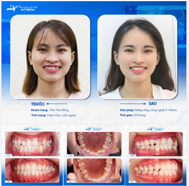 TỪ TỰ TI VÌ “MẶT LƯỠI CÀY” ĐẾN NỤ CƯỜI TRUYỀN CẢM HỨNG