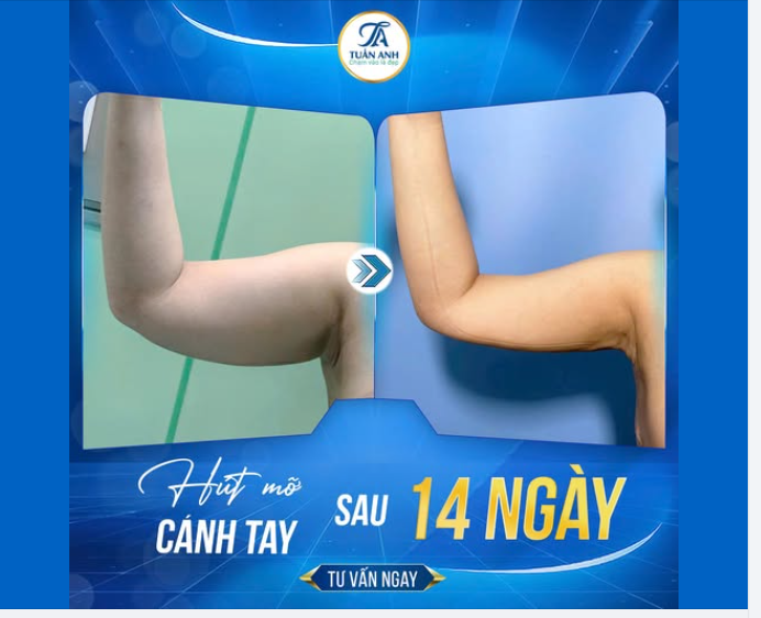 Cánh tay thon gọn, mặc đồ gì cũng đẹp