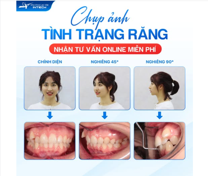 GỬI ẢNH TÌNH TRẠNG RĂNG – NHẬN TƯ VẤN CHUẨN TỪ BÁC SĨ LẠC VIỆT INTECH