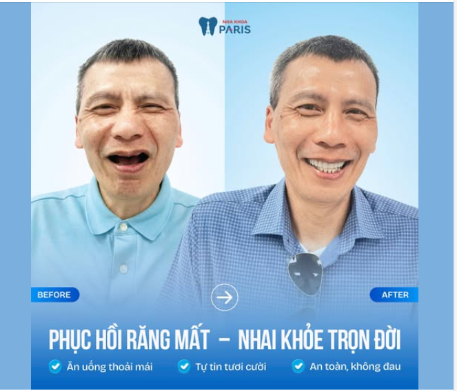 Phục hồi răng mất ​​​​​​​răng  Nhai khỏe trọn đời
