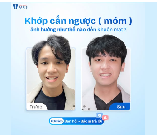 KHỚP CẮN NGƯỢC ẢNH HƯỞNG NHƯ THẾ NÀO ĐẾN THẨM MỸ KHUÔN MẶT
