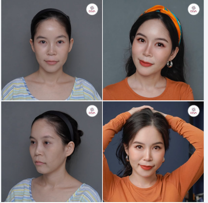 CẤY MỠ + TIÊM PROFHILO: CÔNG THỨC "2 TRONG 1" GIÚP GƯƠNG MẶT TRẺ TRUNG ĐÁNG KINH NGẠC