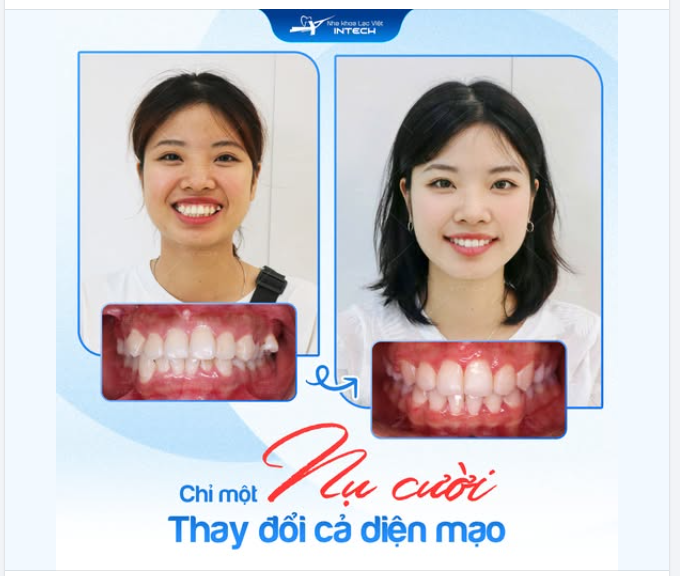 ĐEO NIỀNG 2 NĂM, "LÃI" CẢ SỰ TỰ TIN SUỐT ĐỜI