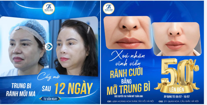 Xóa vĩnh viễn rãnh cười, gương mặt trở nên trẻ trung hơn với phương pháp độc quyền Cấy mỡ trung bì