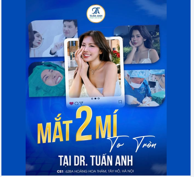 Mắt 2 mí to tròn, tự nhiên tại Thẩm mỹ Tuấn Anh
