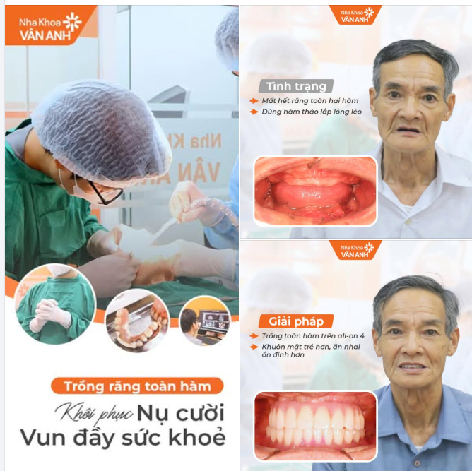TRỒNG RĂNG IMPLANT TOÀN HÀM KHÔI PHỤC NỤ CƯỜI, VUN ĐẦY SỨC KHOẺ