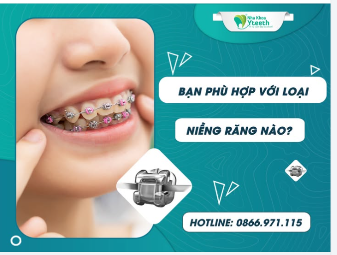 Bạn phù hợp với loại niềng răng nào? Mắc cài kim loại?