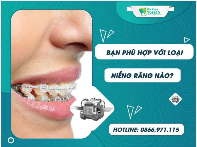 Bạn phù hợp với loại niềng răng nào? Niềng răng mắc cài sứ – Vừa đẹp vừa hiệu quả!