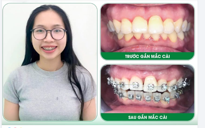 ĐÓN HÈ TỰ TIN - ĐẦU TƯ CHO NỤ CƯỜI HOÀN MỸ