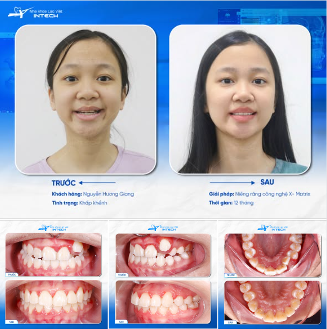 Niềng răng sớm – Quyết định nhỏ, thay đổi lớn cho tương lai