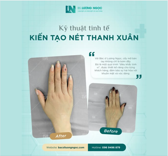 CẤY MỠ BÀN TAY TẠI BÁC SĨ LƯƠNG NGỌC: KỸ THUẬT TINH TẾ KIẾN TẠO NÉT THANH XUÂN
