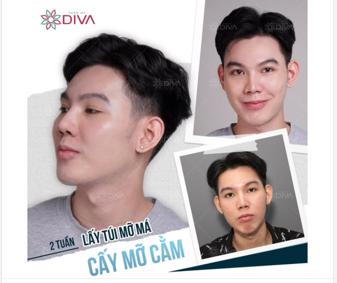 2 TUẦN SAU KHI LẤY TÚI MỠ MÁ TRONG VÀ CẤY MỠ CẰM – GƯƠNG MẶT CÂN ĐỐI, THẦN THÁI CŨNG ĐỔI THAY