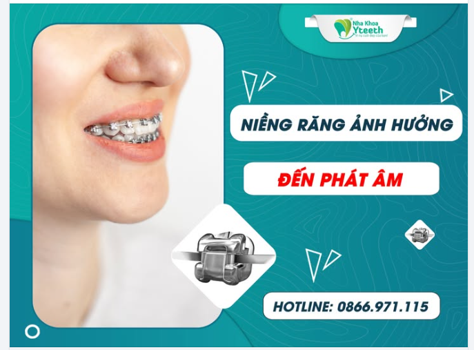 Rất nhiều người trì hoãn việc niềng răng vì sợ ảnh hưởng đến giao tiếp, học hành hay công việc – đặc biệt là những ai làm nghề nói nhiều như giáo viên, MC, sinh viên...