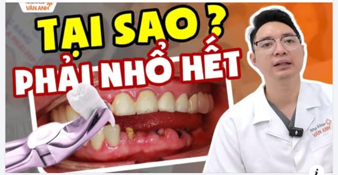 52 tuổi, còn nửa hàm răng… nhưng bác sĩ lại chỉ định NHỔ HẾT để trồng implant từ đầu?