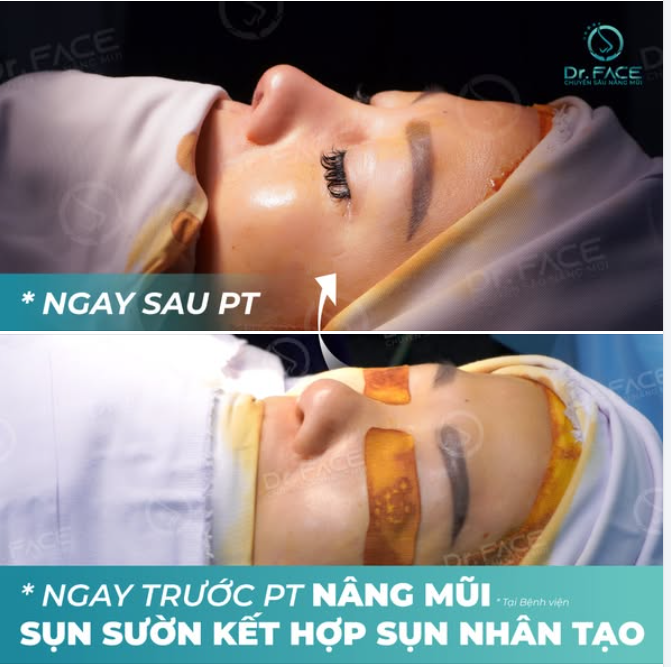 Khoảnh khắc bạn ấy mở mắt, chạm tay khẽ vào mũi rồi mỉm cười – BS hiểu rằng, điều mình làm không chỉ thay đổi dáng mũi, mà còn trả lại cho bạn một vui khác biệt.