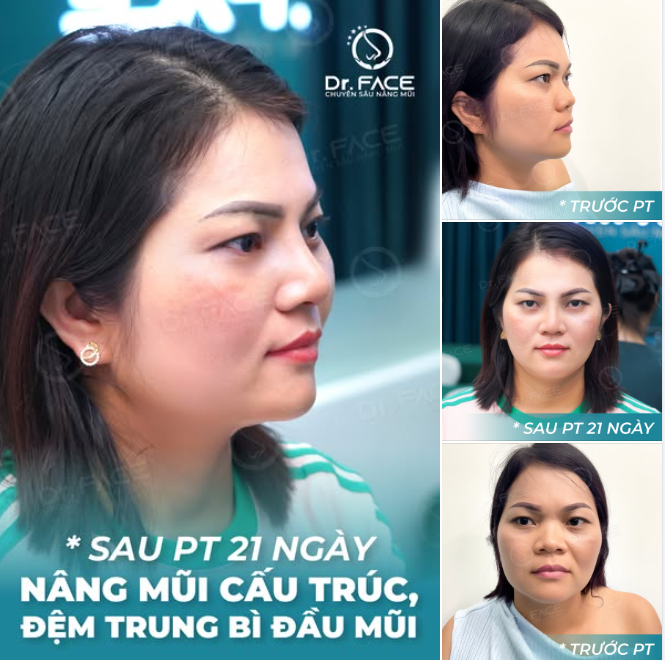 CHỈNH DÁNG MŨI – THAY ĐỔI LUÔN CẢ GÒ MÁ