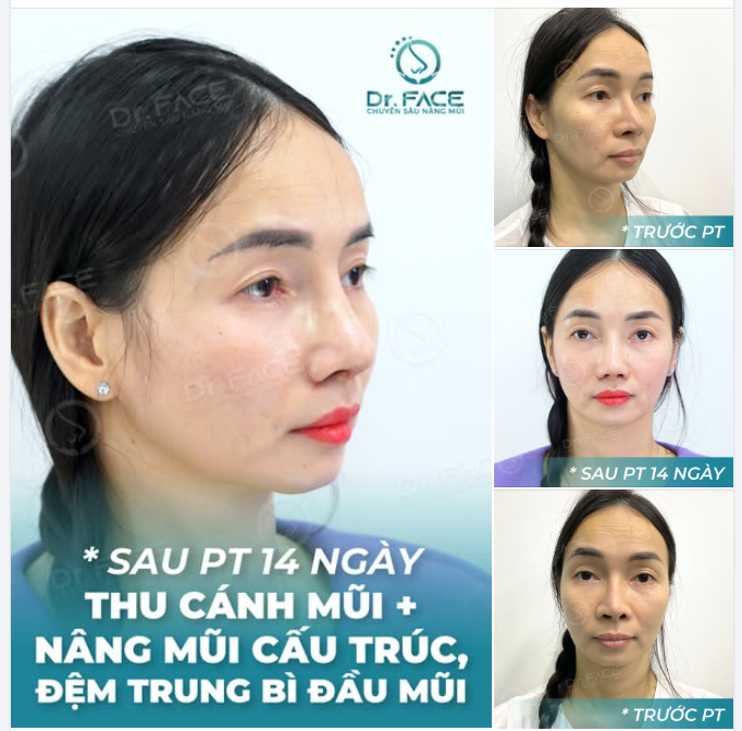 Giờ thì chiếc đầu mũi tròn mềm đã mang lại cho bạn sự tự tin và niềm vui mỗi ngày.