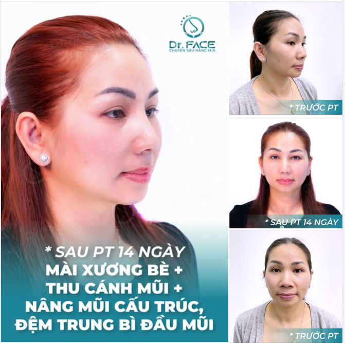 COMBO CHỈNH SỬA TOÀN DIỆN MŨI