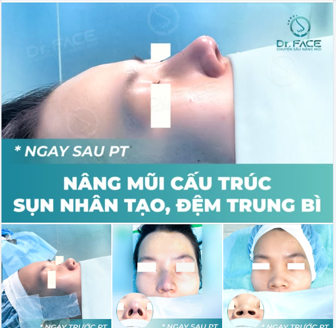 MŨI CAO VỪA ĐỦ, TRÒN MỀM TỰ NHIÊN