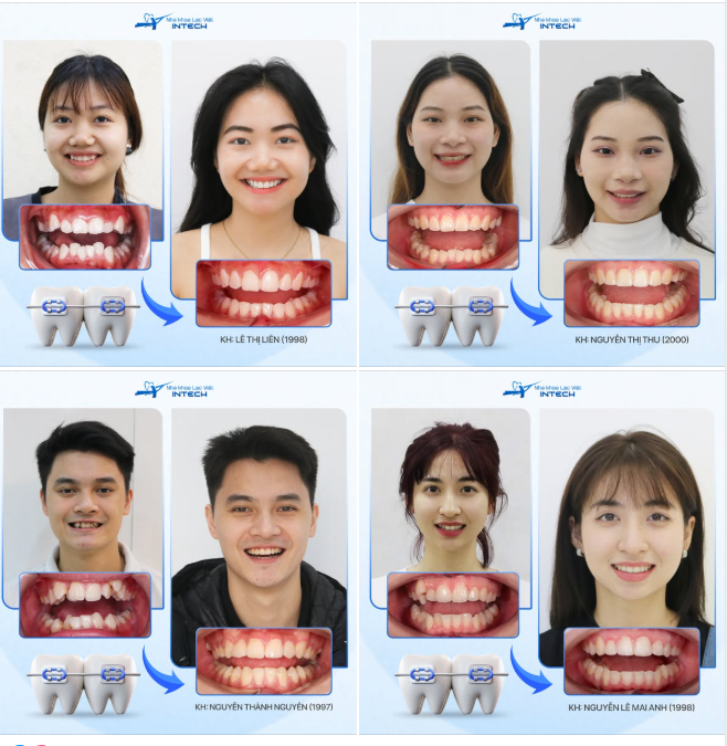 HƠN 70% KHÁCH HÀNH QUYẾT ĐỊNH NIỀNG RĂNG VÌ MUỐN CẢI THIỆN TÍNH THẨM MỸ