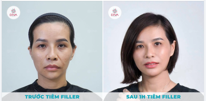KHÓE MŨI MIỆNG SÂU - CẢI THIỆN ĐÚNG CÁCH NHƯ THẾ NÀO?