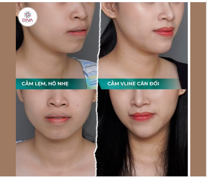 CẤY MỠ CẰM – “CHỮA” CẰM LẸM, TĂNG ĐỘ NHÔ, CHO MẶT V-LINE TỰ NHIÊN
