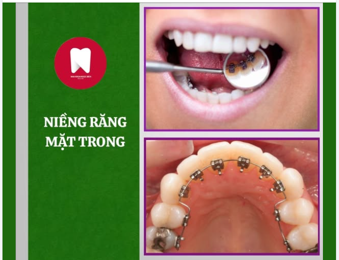 PHƯƠNG PHÁP NIỀNG RĂNG MẮC CÀI MẶT TRONG