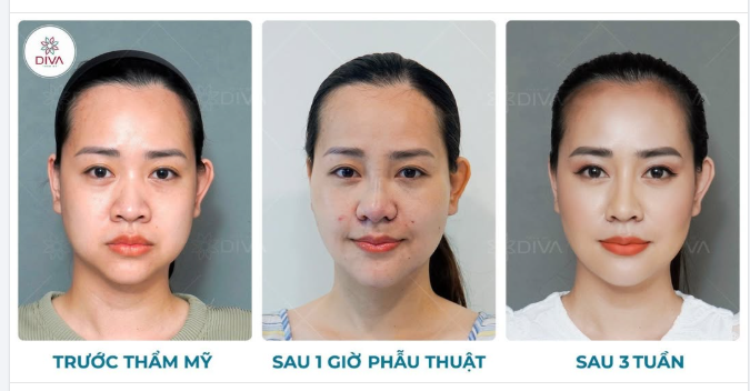 SỞ HỮU NHAN SẮC “NHÌN LÀ MÊ” CỦA NGƯỜI MẸ 3 CON SAU THẨM MỸ