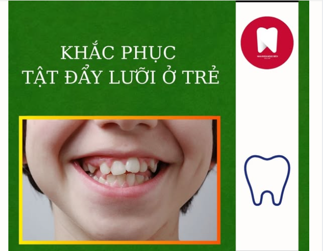 TẬT ĐẨY LƯỠI Ở TRẺ - ĐIỀU TRỊ SỚM CÀNG CÓ LỢI