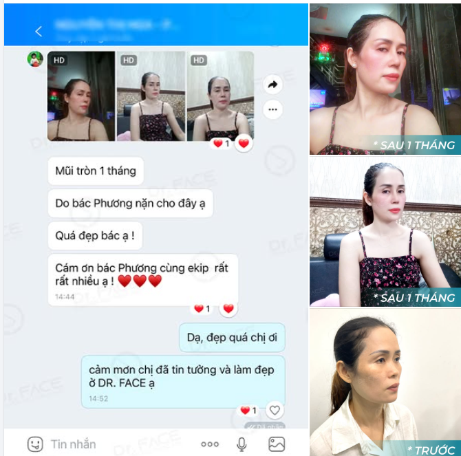 Có những tin nhắn khiến BS đọc xong phải mỉm cười “Mũi tròn 1 tháng, quá đẹp bác ạ! Cám ơn bác Phương cùng ekip rất rất nhiều ​​​​​​​”.
