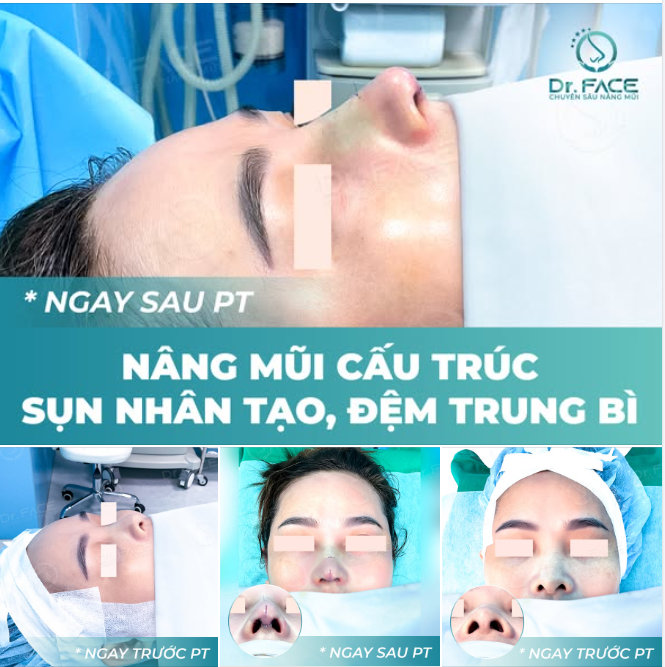 Chị khách này đã theo dõi BS gần 10 năm. Dáng mũi ban đầu sống thấp, đầu mũi to bè, lại có khuyết khá nhiều ở hai bên cánh mũi.