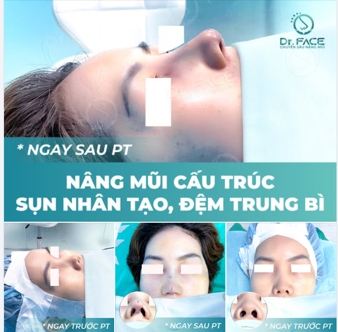 TÌM LẠI SỰ TỰ TIN GÓC MŨI NGHIÊNG