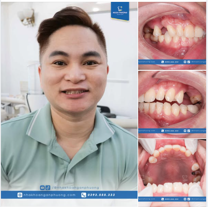 3 tác hại của mất răng sớm mà quên phục hình