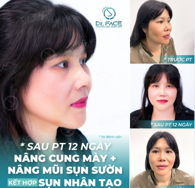 Kết quả khi trở về Hàn Quốc mọi người đều khen đẹp với trẻ ra, công nhận về VN làm là hợp lý.