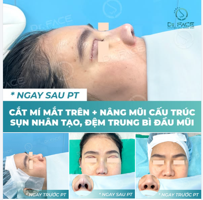 Ngay sau khi làm xong chị rất ưng, cả 2 đều đẹp hơn mong đợi, chọn tiền m ê nên không đau gì cả.