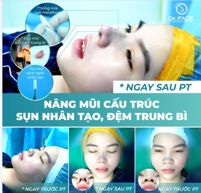 Chi tiết 3 BƯỚC nâng mũi CẤU TRÚC ĐỆM TRUNG BÌ