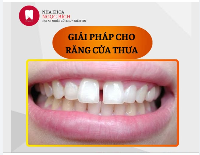 GIẢI PHÁP NÀO CHO TÌNH TRẠNG RĂNG CỬA THƯA