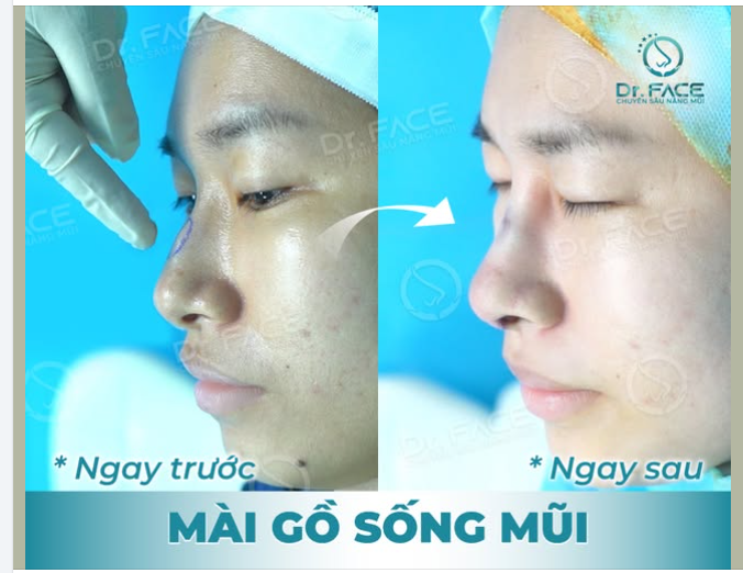 Tưởng phải NÂNG CẤU TRÚC ai ngờ BS CHỈ CHO MÀI GỒ