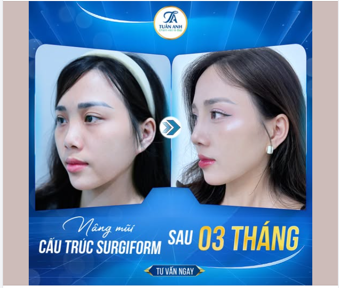NÂNG MŨI SỤN SURGIFORM – DÁNG MŨI CHUẨN TỶ LỆ, ĐẸP TỰ NHIÊN LÂU DÀI