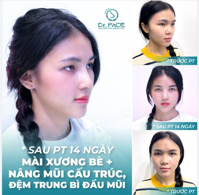 Sống mũi thẳng đẹp như mơ,  Ai nhìn cũng phải ngẩn ngơ mấy lần.