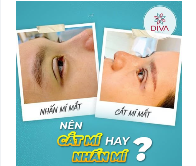 MẮT ĐẸP TỰ NHIÊN – NÊN NHẤN MÍ HAY CẮT MÍ 2 MÍ?