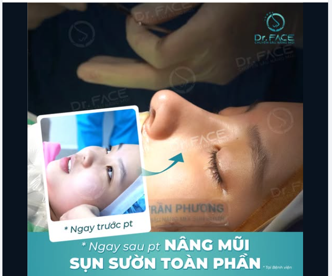 THẬT SỰ RUNG ĐỘNG VỚI CHIẾC MŨI NÀY