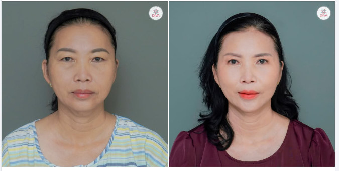 CẢI THIỆN TÌNH TRẠNG SỤP MÍ, DA DƯ VÙNG MẮT Ở NGƯỜI LỚN TUỔI - LẤY LẠI NÉT TƯƠI TRẺ CHO KHUÔN MẶT