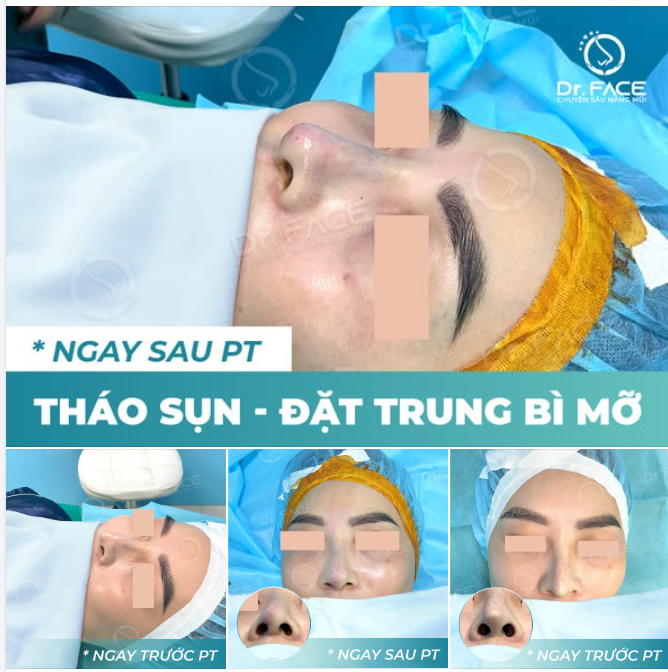 NHÌN CHIẾC MŨI CŨ CỦA BẠN MÀ BS THẤY XÓT…
